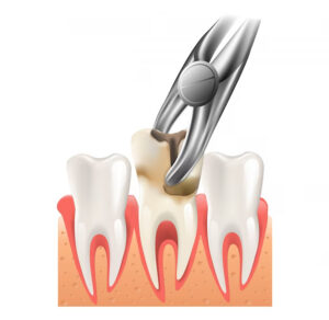 dental extraction, tooth extraction, pull out tooth , tooth pain