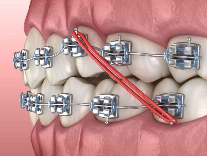 Dental braces