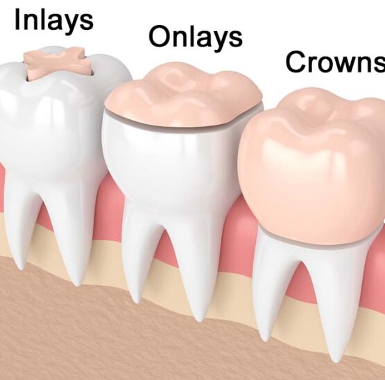 inlay and onlay treatments