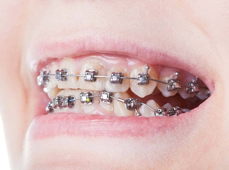 damon-braces