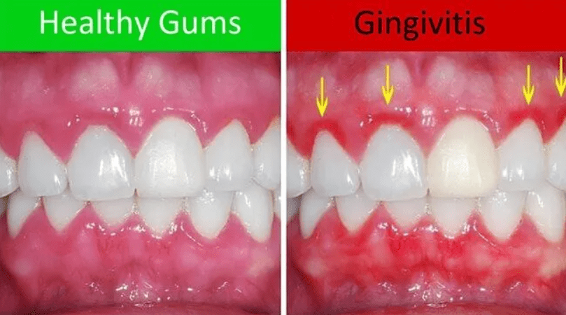 gingivitis