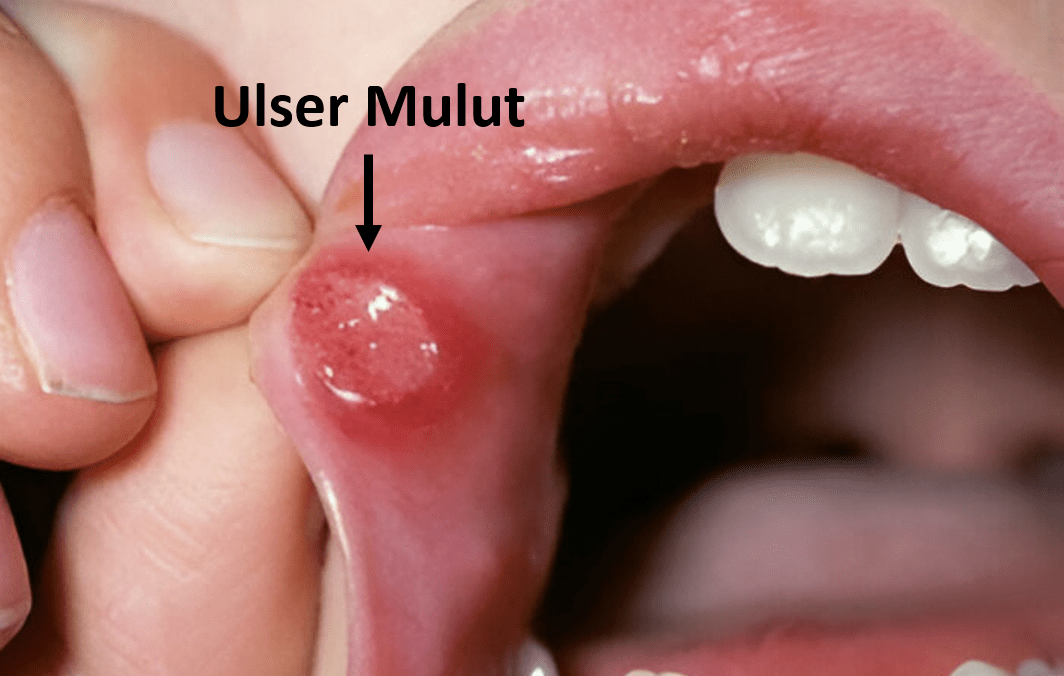 kebengkakan ulser mulut