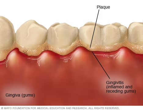 gingivitis