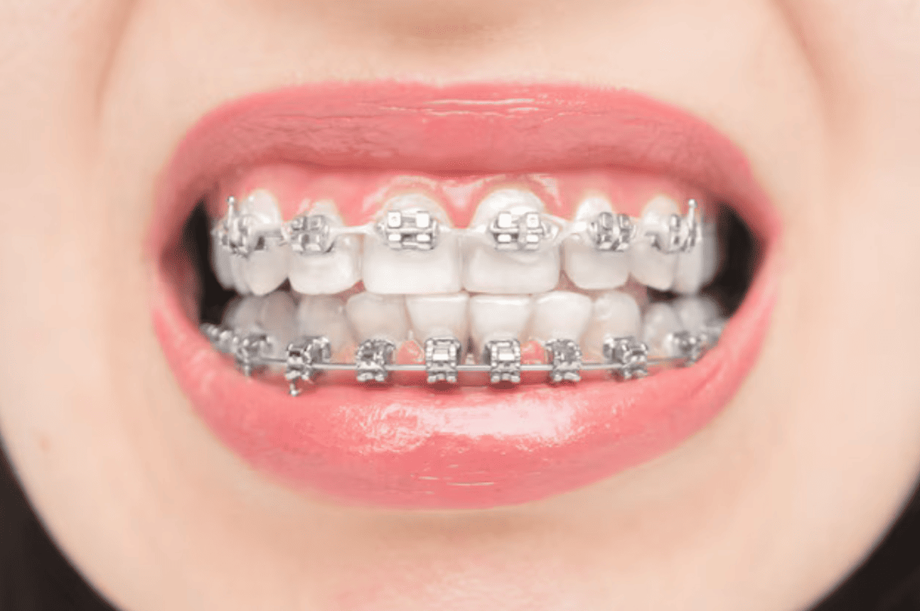 Apa itu braces self-ligating