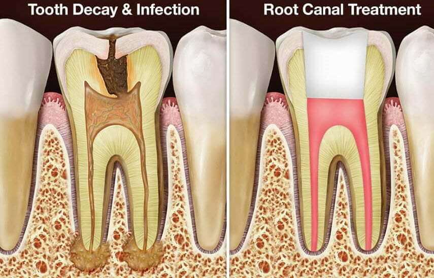 apa itu rawatan akar gigi
