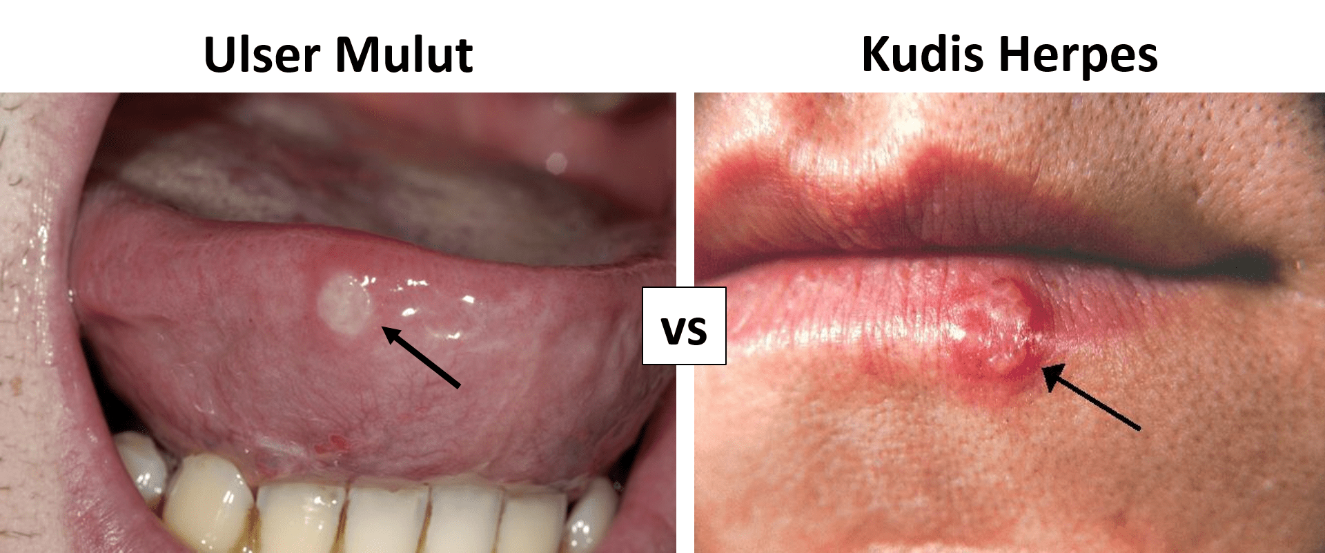 perbezaan ulser mulut dan kudis herpes