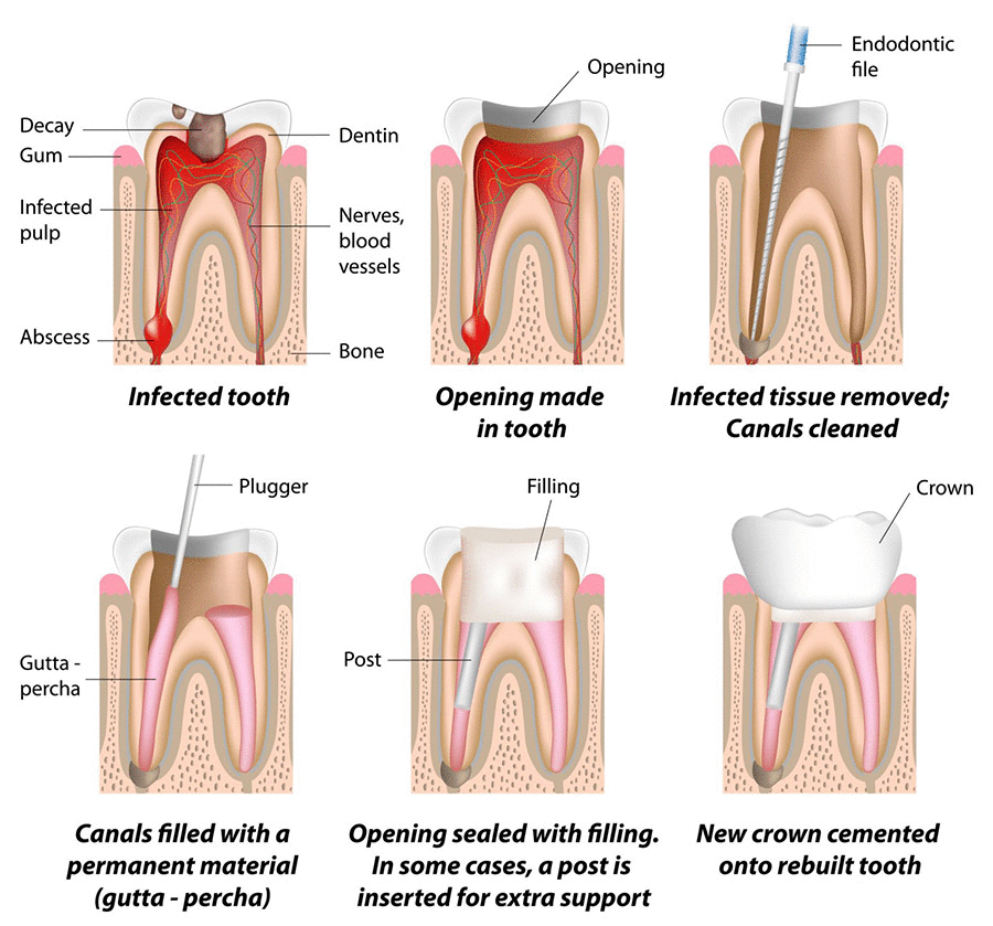 proses rawatan akar gigi