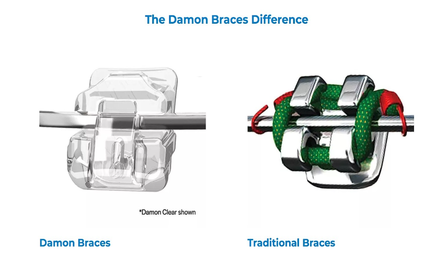 damon braces vs traditional braces