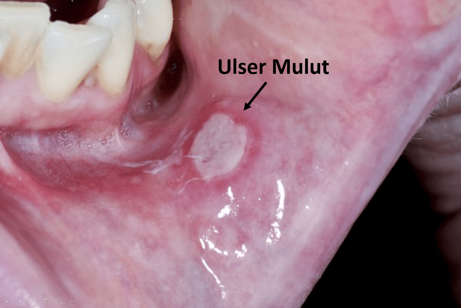 contoh ulser mulut