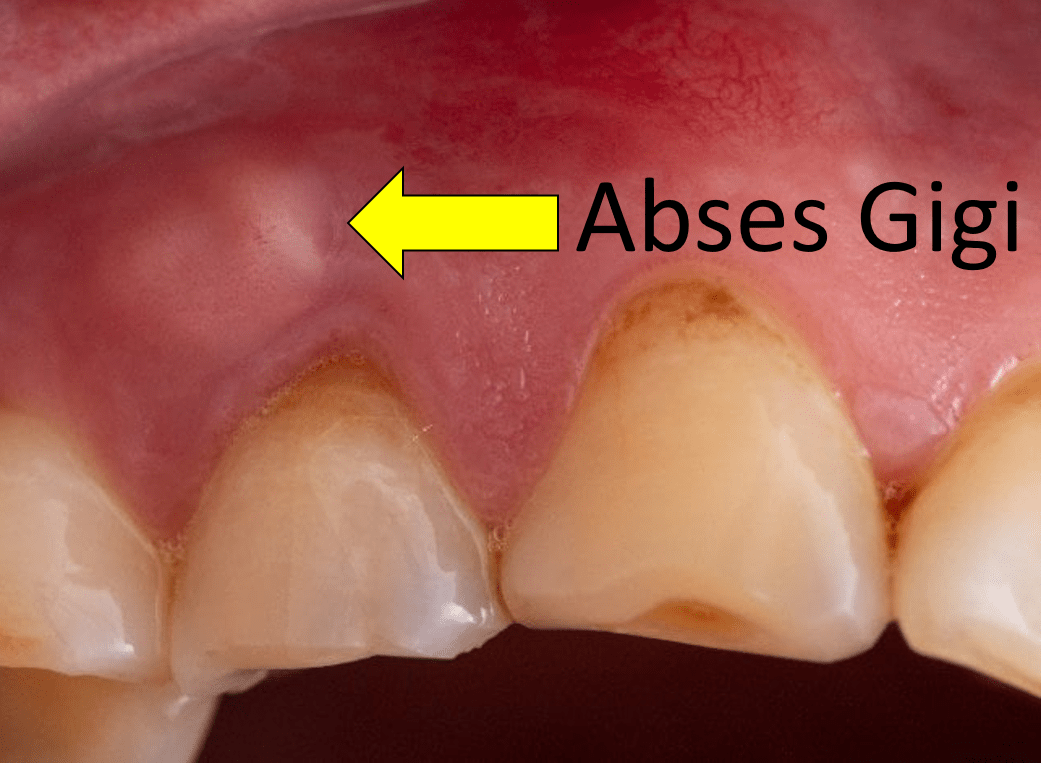 abses gigi