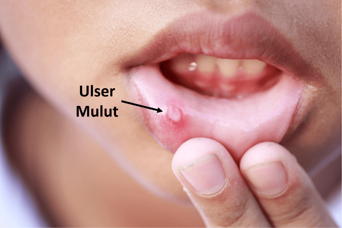 contoh ulcer mulut