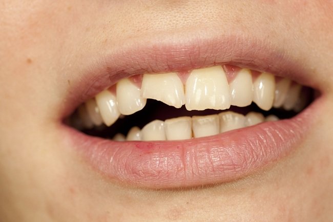 contoh gigi retak