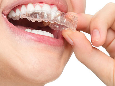 clear correct clear aligner invisible braces