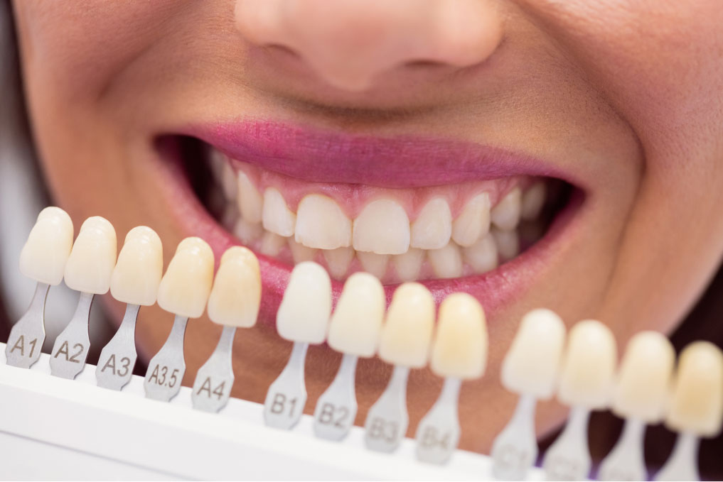 dental composite veneers