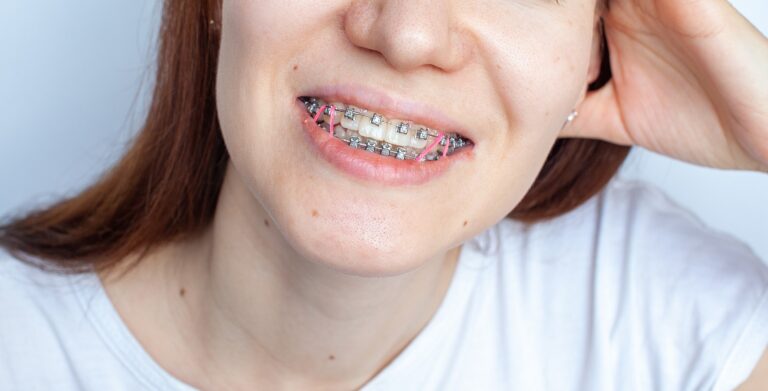 rubber band for braces