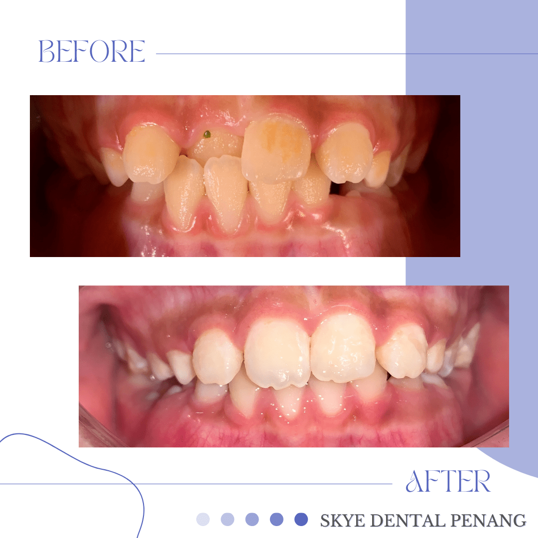 Before and after crossbite