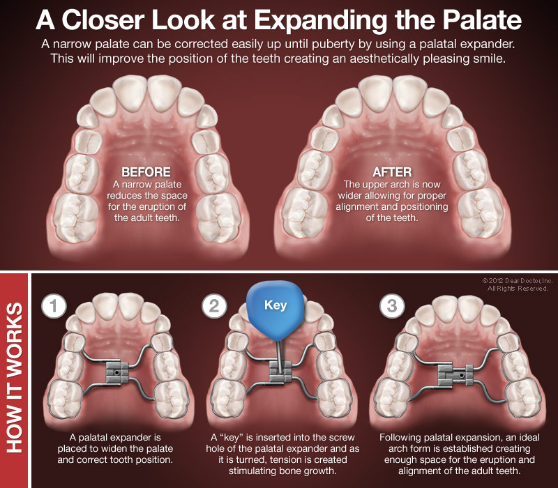 infographic of palatal expanders