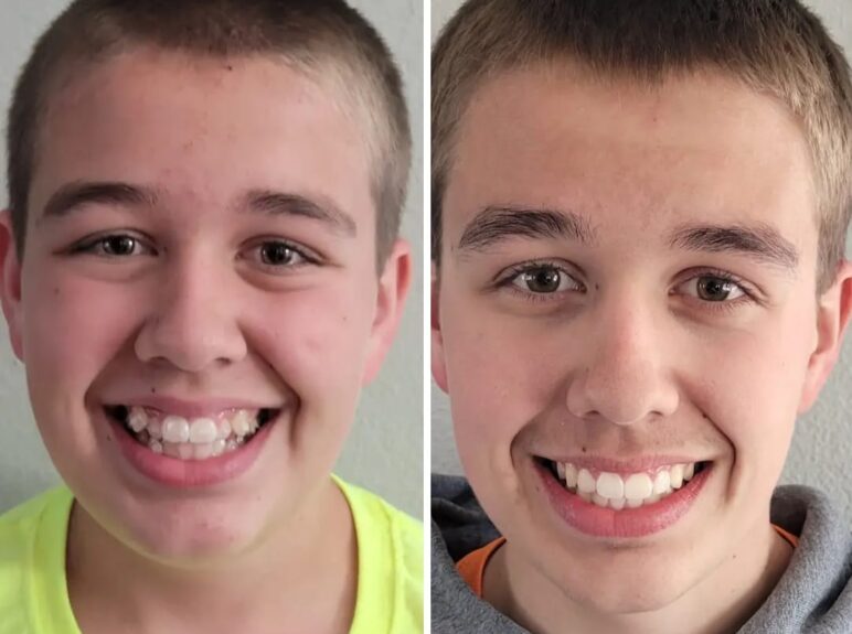 comparison before and after wearing braces