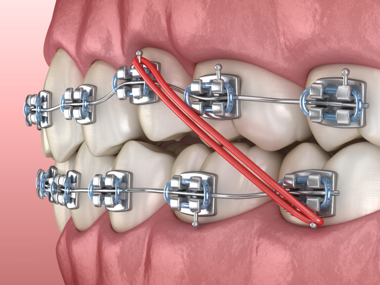 dental braces