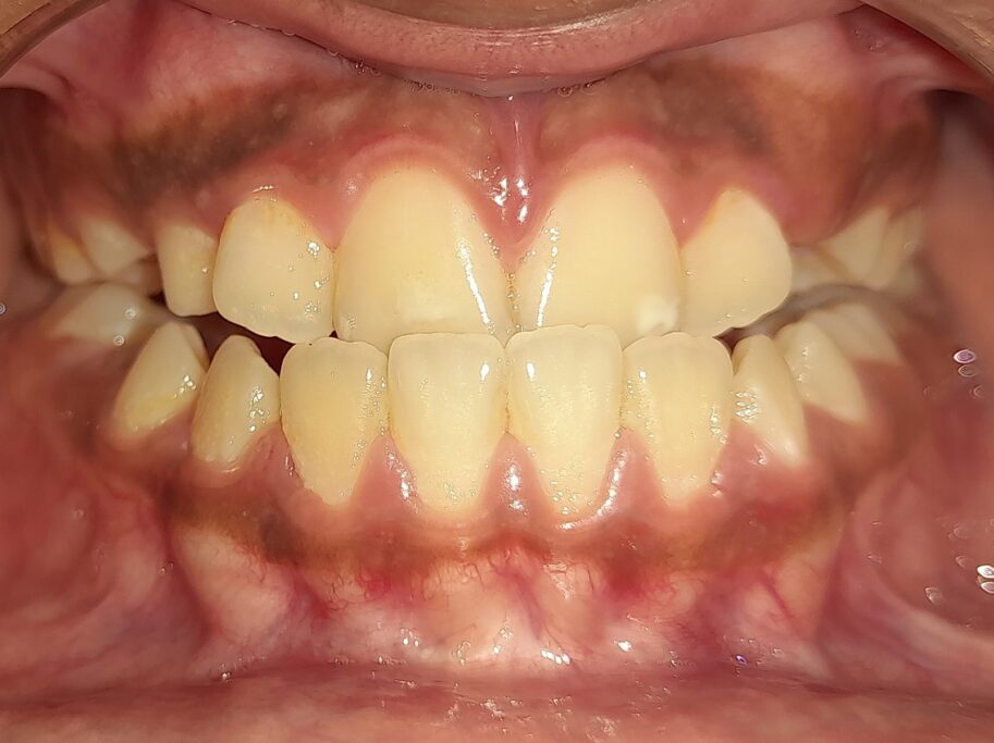 Anterior crossbite