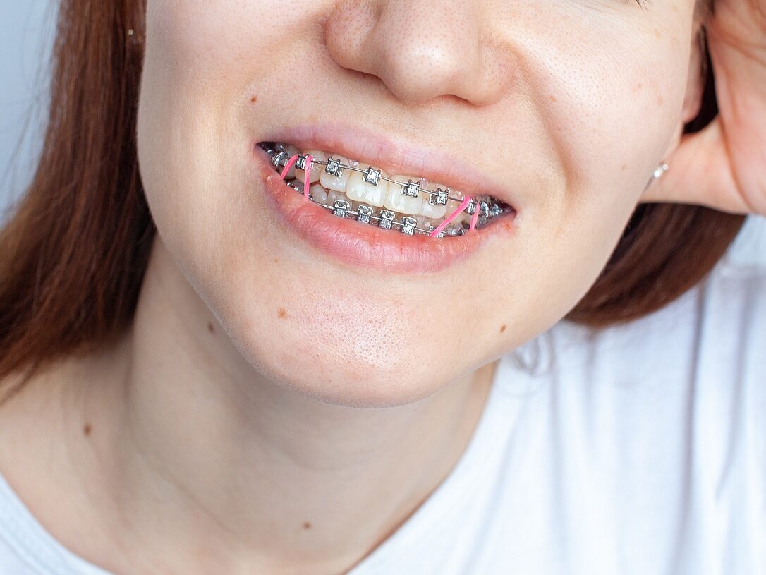 rubber band for braces