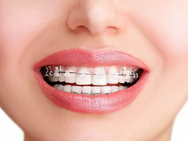 Braces, Invisalign & Myobrace - Skye Dental Penang