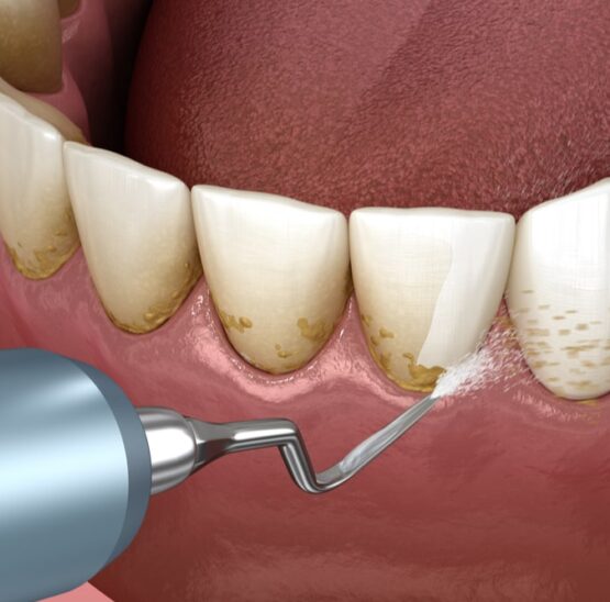 dental scaling