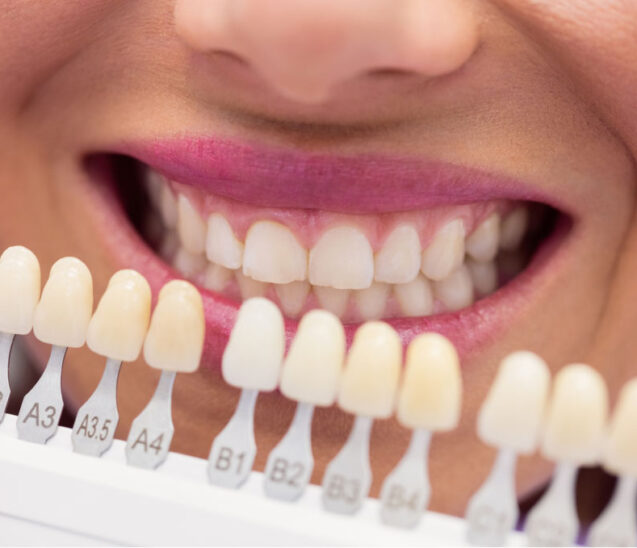 dental composite veneers
